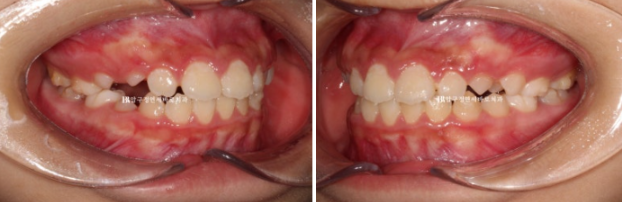강남 소아교정 인비절라인 퍼스트 어린이 반대교합 관련 이미지 7