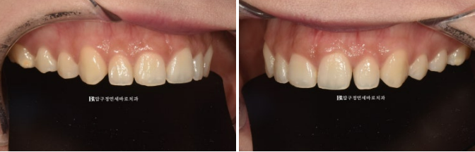 How to Create a Beautiful Smile Line? | A Real Case of Changing a Smile with No-Prep Laminates image 2