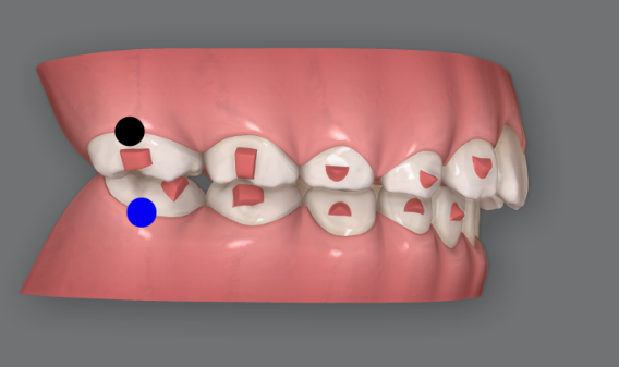 Invisalign First Correction for a Retruded Chin in a Child Orthodontic Treatment for Protrusion image 8