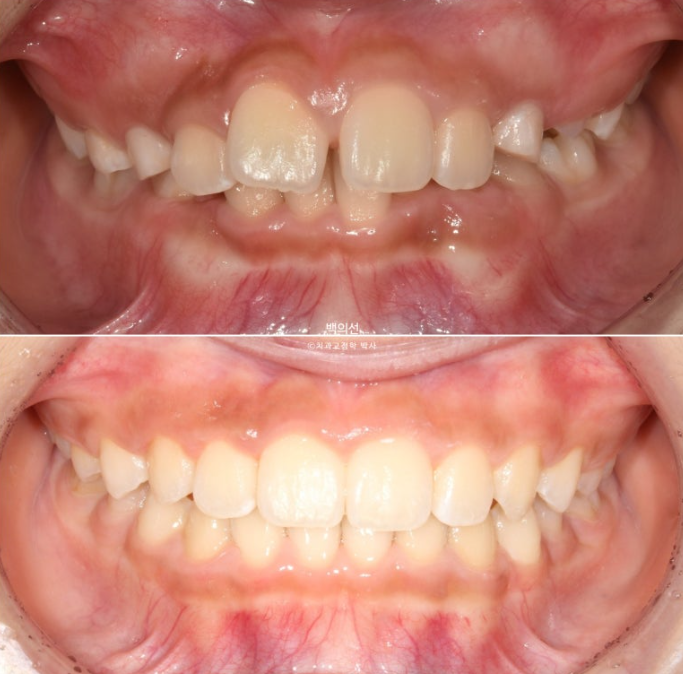인비절라인퍼스트 어린이 투명교정 과개교합 덧니 악궁확장 돌출 관련 이미지 1