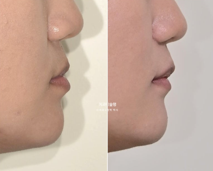 비발치 비수술 주걱턱 반대교합 재교정 치료 관련 이미지 1