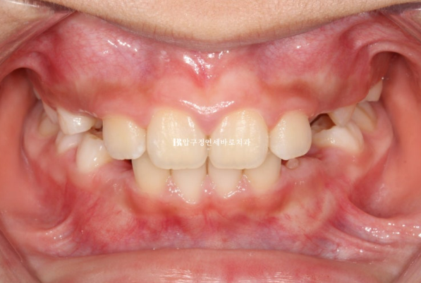 Invisalign First Correction for a Retruded Chin in a Child Orthodontic Treatment for Protrusion image 16