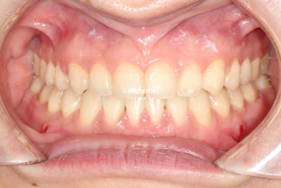 앞니 벌어짐 합죽이 방지 교정 기간 1년 4개월 관련 이미지 9