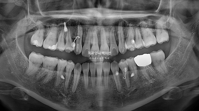 비발치 교정 덧니 인비절라인 교정 절단교합 반대교합 치료기간 1년 6개월 관련 이미지 28
