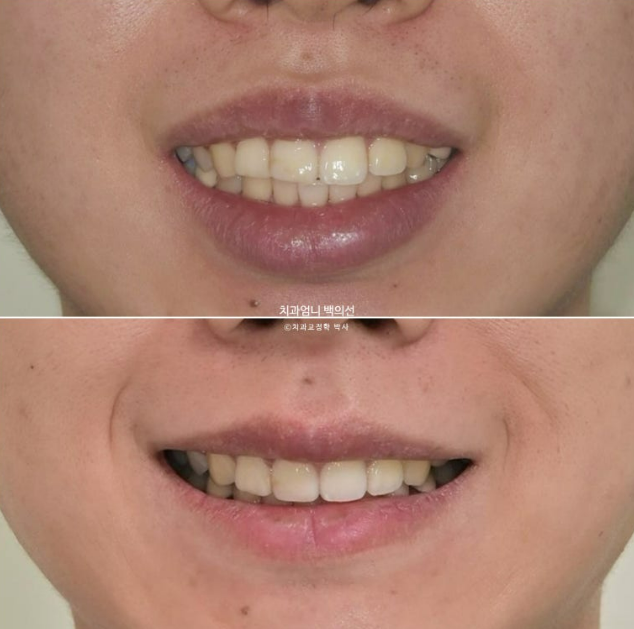 돌출입 발치 교정 인비절라인 후기 미니스크류 관련 이미지 21