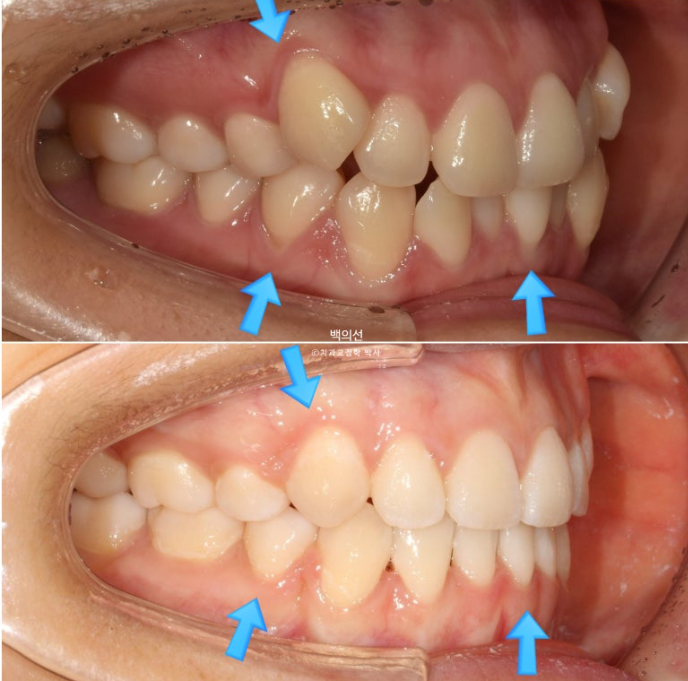 덧니 발치교정 클리피씨 입매 부작용 인중 입술 잇몸 퇴축 관련 이미지 14