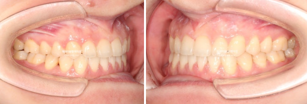앞니 벌어짐 합죽이 방지 교정 기간 1년 4개월 관련 이미지 10