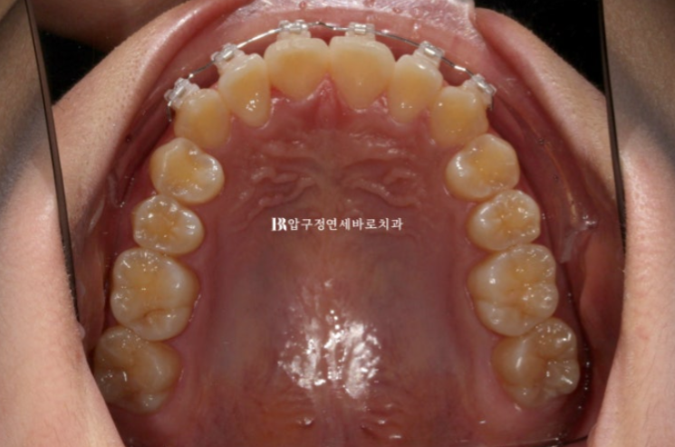 덧니교정 앞니부분교정 치간삭제 후기 관련 이미지 5