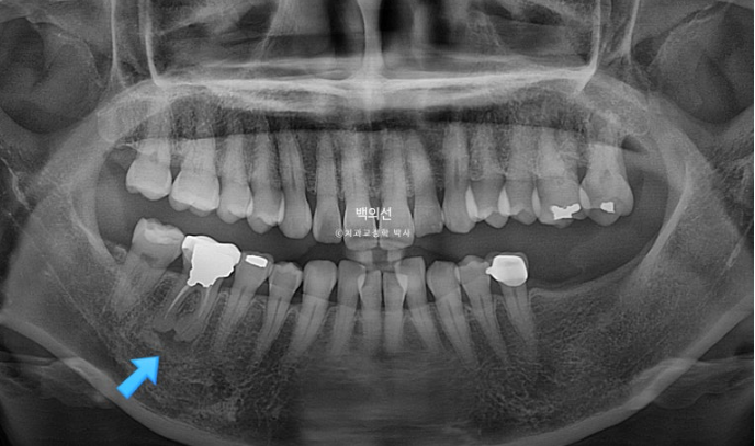 40대 인비절라인 라이트 앞니 돌출 과개교합 덧니 교정 후기 관련 이미지 7