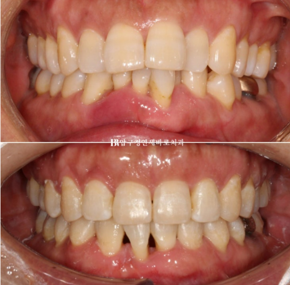 40대 치아교정 가능할까요? 치주염 있어도 치아교정 가능할까요? 임플란트 없이 교정하기 관련 이미지 12