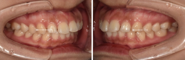 돌출입 교정 치아 벌어짐 인비절라인 투명교정 치료 관련 이미지 3