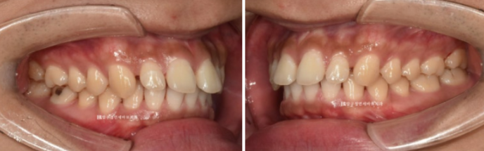 Can Invisalign Fix a Gap Between the Front Teeth? ๐ฎ A Real 9-Month Case Finished Without Remaking Aligners image 2