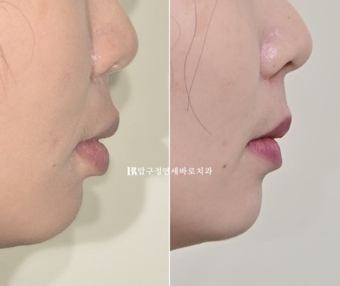 인비절라인 돌출입 발치교정 거미스마일 잇몸미소 교정 관련 이미지 15