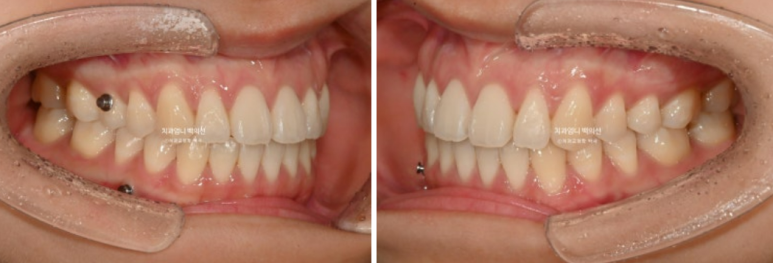 인비절라인 개방교합 교정 어금니 함입 교정 비베라? 관련 이미지 10