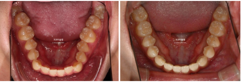 비수술 비발치 주걱턱 절충치료 클리피씨 개방교합 반대교합 치료 관련 이미지 13