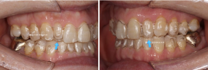 Can It Be Done in Your 50s? Real Results from Limited Front Teeth Orthodontics + No-Prep Laminate Veneers Revealed image 6