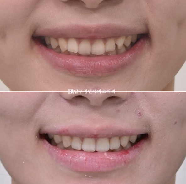 If Inward-Tilted Teeth Make Your Smile Look Constricted? Invisalign Before and After image 16