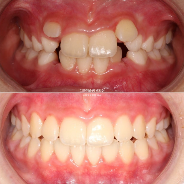 어린이 무턱 성장교정 덧니 인비절라인 퍼스트 악궁확장 치료기간 2년 관련 이미지 28