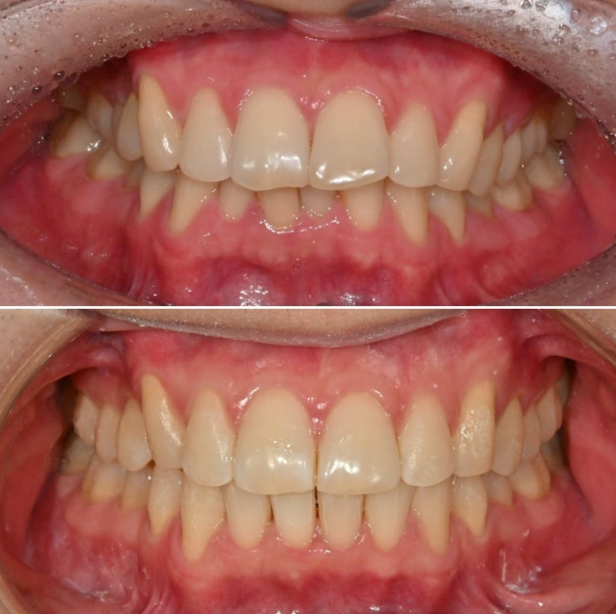 인비절라인 라이트 돌출 과개교합 중심선 교정 치간삭제 치료기간 관련 이미지 13