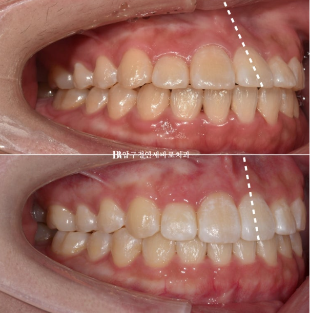 서울 인비절라인 치과 재교정 뻐드렁니 교정 관련 이미지 8