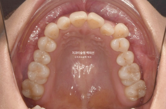 옥니 덧니 과개교합 반대교합 중심선 인비절라인 치료기간 1년 관련 이미지 4