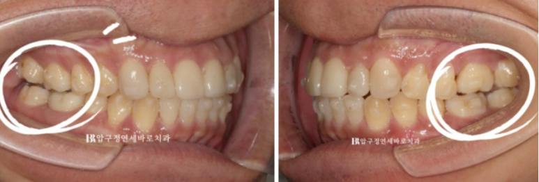 40대 중년 치아교정 인비절라인 라이트 치료기간 8개월 관련 이미지 8