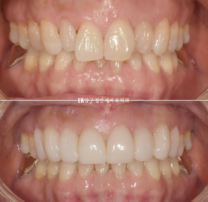Can It Be Done in Your 50s? Real Results from Limited Front Teeth Orthodontics + No-Prep Laminate Veneers Revealed image 14