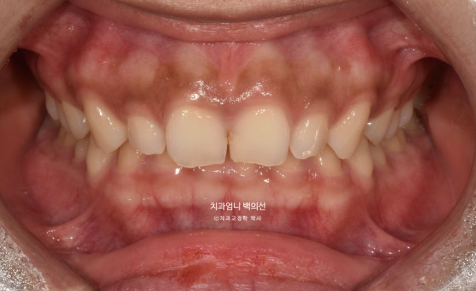 과개교합 옥니 거미스마일 교정 인비절라인 라이트 잇몸성형 후기 관련 이미지 2