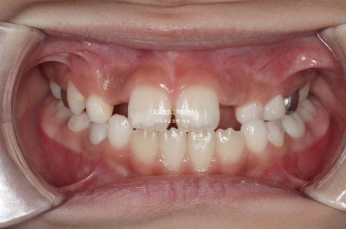 어린이 교정 인비절라인 퍼스트 비대칭 반대교합 어린이 성장 교정 관련 이미지 2