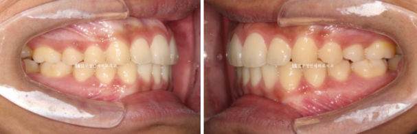 인비절라인 라이트 교정 덧니 이소맹출 반대교합 관련 이미지 10