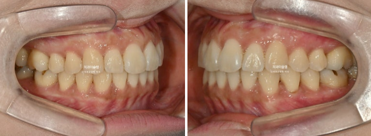 비발치 돌출입 인비절라인 교정 가위교합 중심선 맞추기 관련 이미지 19