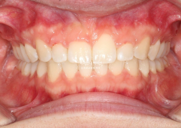 거미스마일 과개교합 교정 잇몸돌출 잇몸 비대칭 관련 이미지 8
