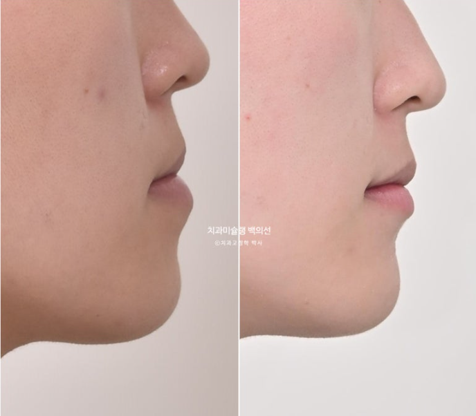 비수술 주걱턱 비대칭 발치 교정 결손치 반대교합 클리피씨 치료기간 1년 11개월 관련 이미지 19