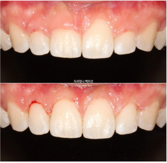 Inward-Tilted Teeth Orthodontic Treatment Review | Actual Case Improved with Non-Extraction Orthodontic Treatment for Gummy Smile, Deep Overbite & Gum Asymmetry — Gangnam Orthodontic Clinic image 9