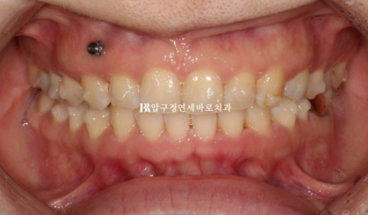 인비절라인 캔팅 교정 과개교합 교정 임플란트 재교정 관련 이미지 4