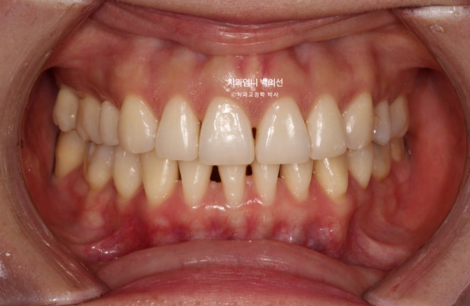 옥니 역교정 재교정 무턱 교정 치료기간 1년 10개월 관련 이미지 2
