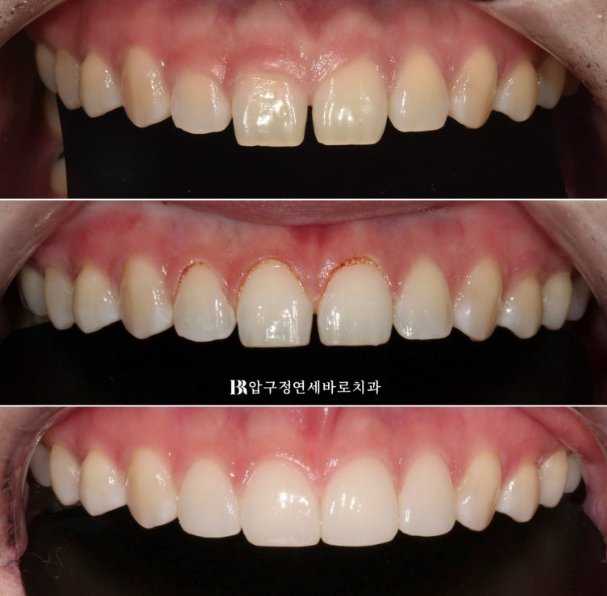 If Your Front Teeth Look Spaced Due to Peg-Shaped Teeth or Microdontia: A Case Choosing No-Prep Veneers Instead of Orthodontic Treatment image 11