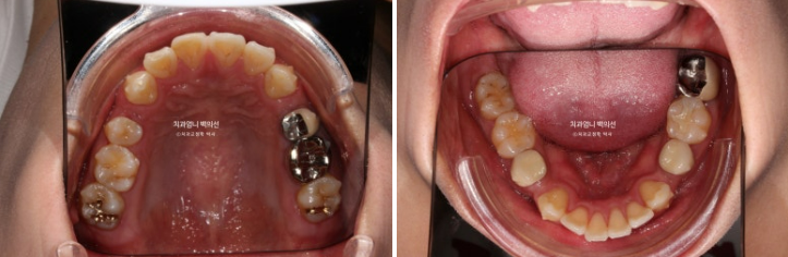 돌출입 발치 교정 인비절라인 후기 미니스크류 관련 이미지 6