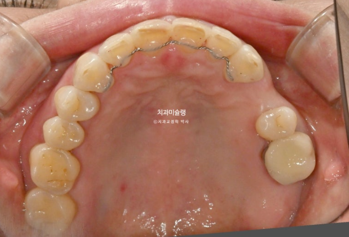 50대 치아교정 돌출 치아벌어짐 중년교정 관련 이미지 14