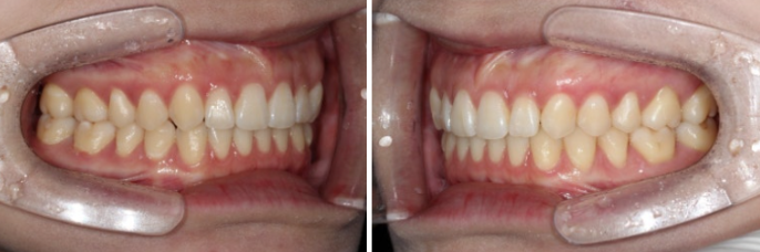 압구정 교정치과 / 옥니교정 인비절라인 라이트 덧니교정 관련 이미지 10