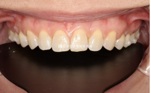 Can Gaps Between the Front Teeth Be Treated with No-Prep Veneers Alone? A Real Case Completed with Gelami After Invisalign Lite image 15