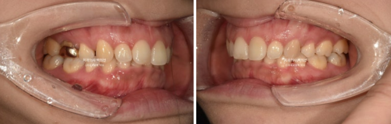 인비절라인 라이트 재교정 발치공간 벌어짐 ? 관련 이미지 2