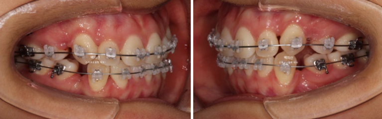 덧니 발치교정 클리피씨 입매 부작용 인중 입술 잇몸 퇴축 관련 이미지 9