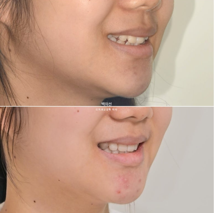 덧니 발치교정 클리피씨 입매 부작용 인중 입술 잇몸 퇴축 관련 이미지 18