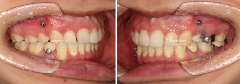 돌출입 발치 교정 인비절라인 후기 미니스크류 관련 이미지 9