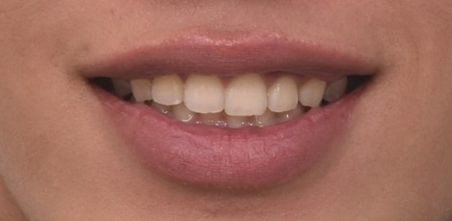 Can Invisalign Lite Correct Deep Bite and the Occlusal Plane? | A Real Case With 14 Aligners Over 4 Months image 2