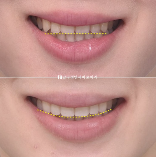 Non-Prep Veneer Review | A Case Naturally Improving Gaps Between the Front Teeth and the Smile Line image 13