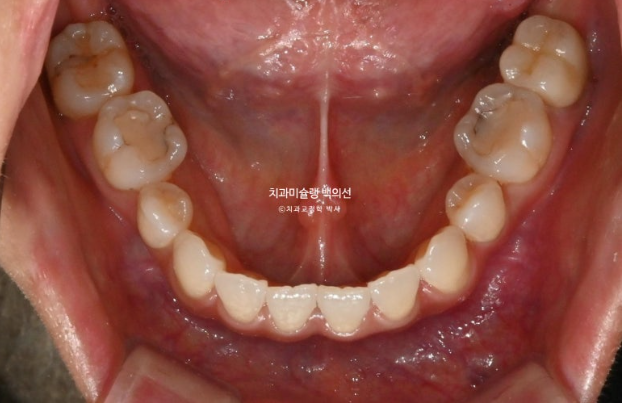 인비절라인 익스프레스 재교정 블랙트라이앵글 치간 삭제 치료기간 6개월 재제작 1회 관련 이미지 6