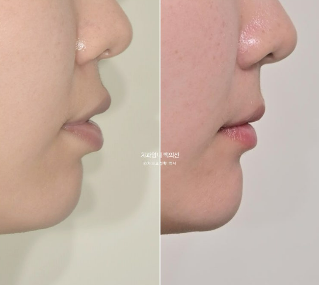 30대 돌출입 발치교정 입술부전증 치료 관련 이미지 17