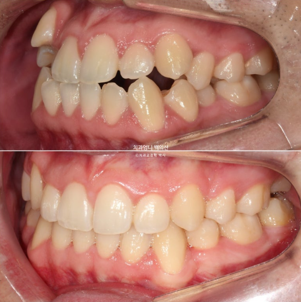 투명교정 인비절라인 덧니 교정 치료기간 알아보기 관련 이미지 13